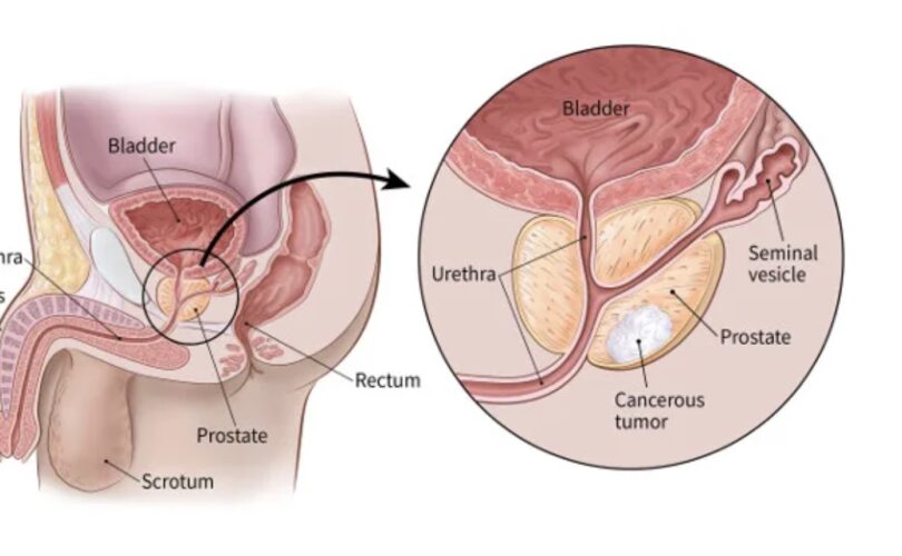 diagram showing cancers cell in Prostate